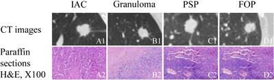 Convolutional Neural Network-Based Diagnostic Model for a Solid, Indeterminate Solitary Pulmonary Nodule or Mass on Computed Tomography